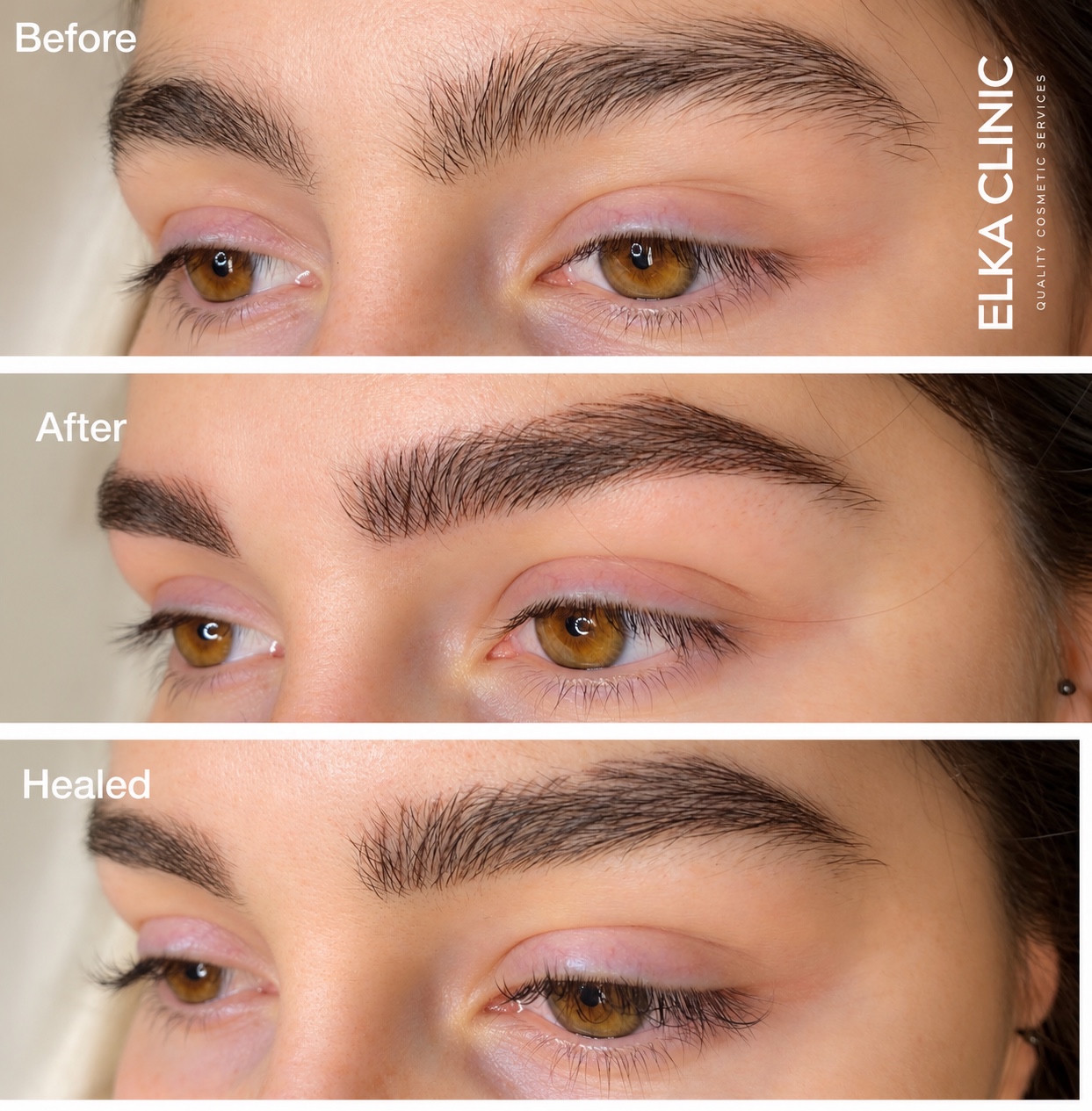 Nano Brows collage showing before treatment, immediately after treatment and healed result