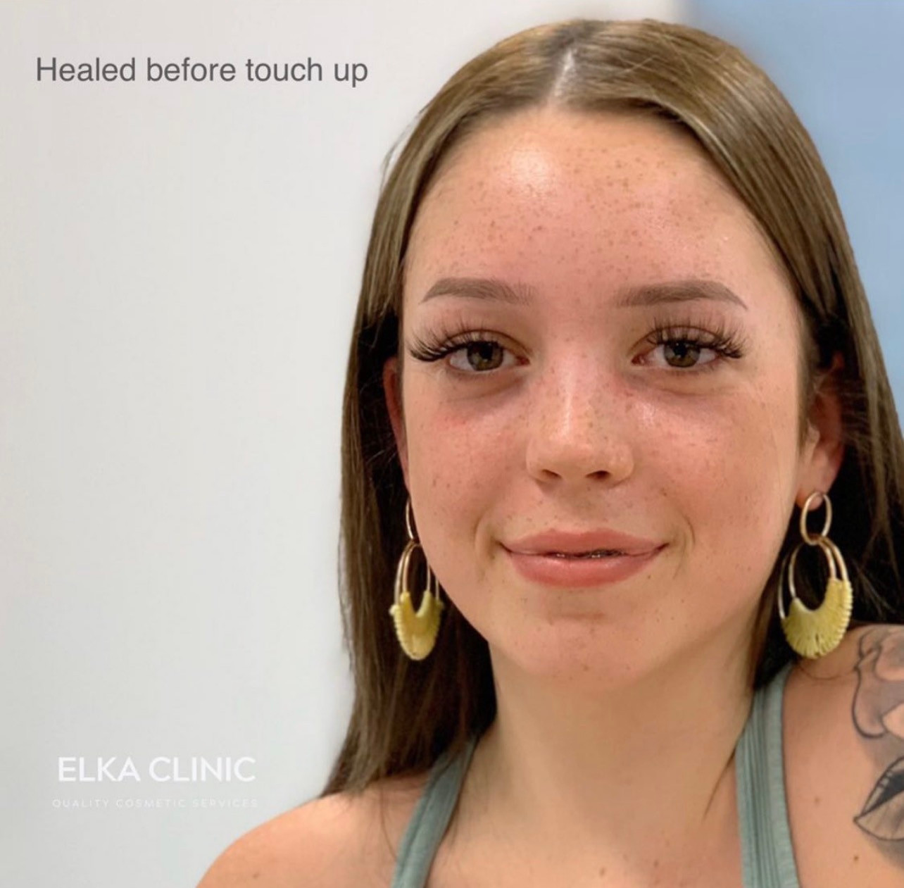 Front-facing portrait showing healed powder brows at ELKA Clinic.