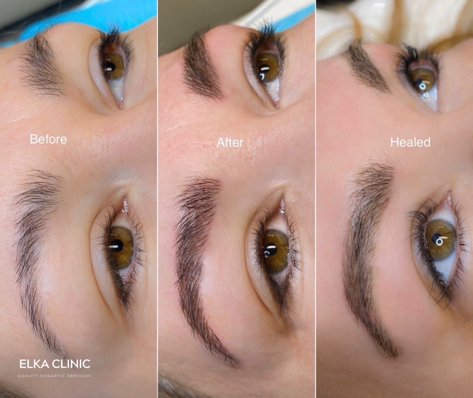 Microblading collage showing before treatment, immediately after treatment and healed result