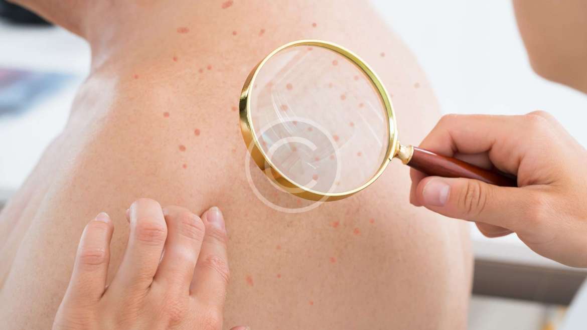 Different types of acne and how to treat them?