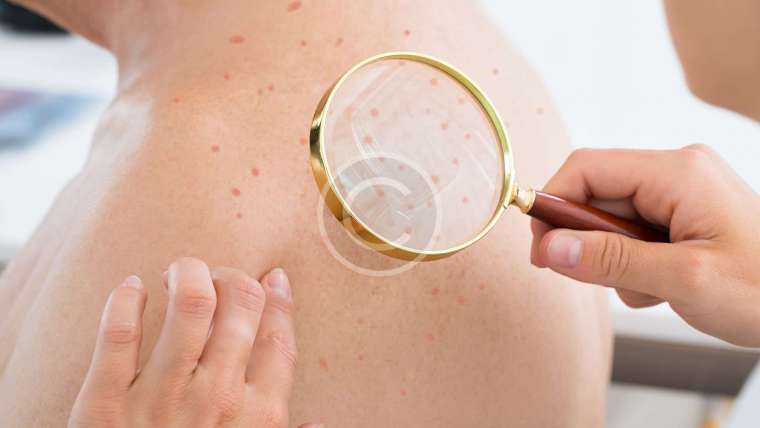 Different types of acne and how to treat them?