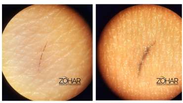 How Deep Should Microblading Be – ELKA CLINIC