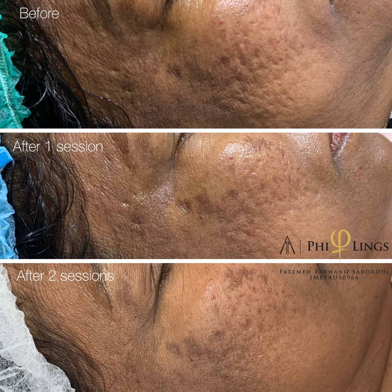 face microneedling for treating acne scar