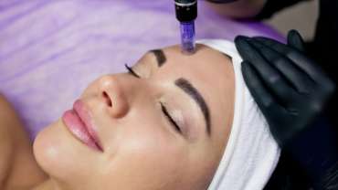 Everything about better looking skin with Microneedling