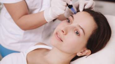 What is microneedling for acne scars?
