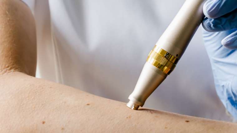 All about Microneedling for Stretch Marks