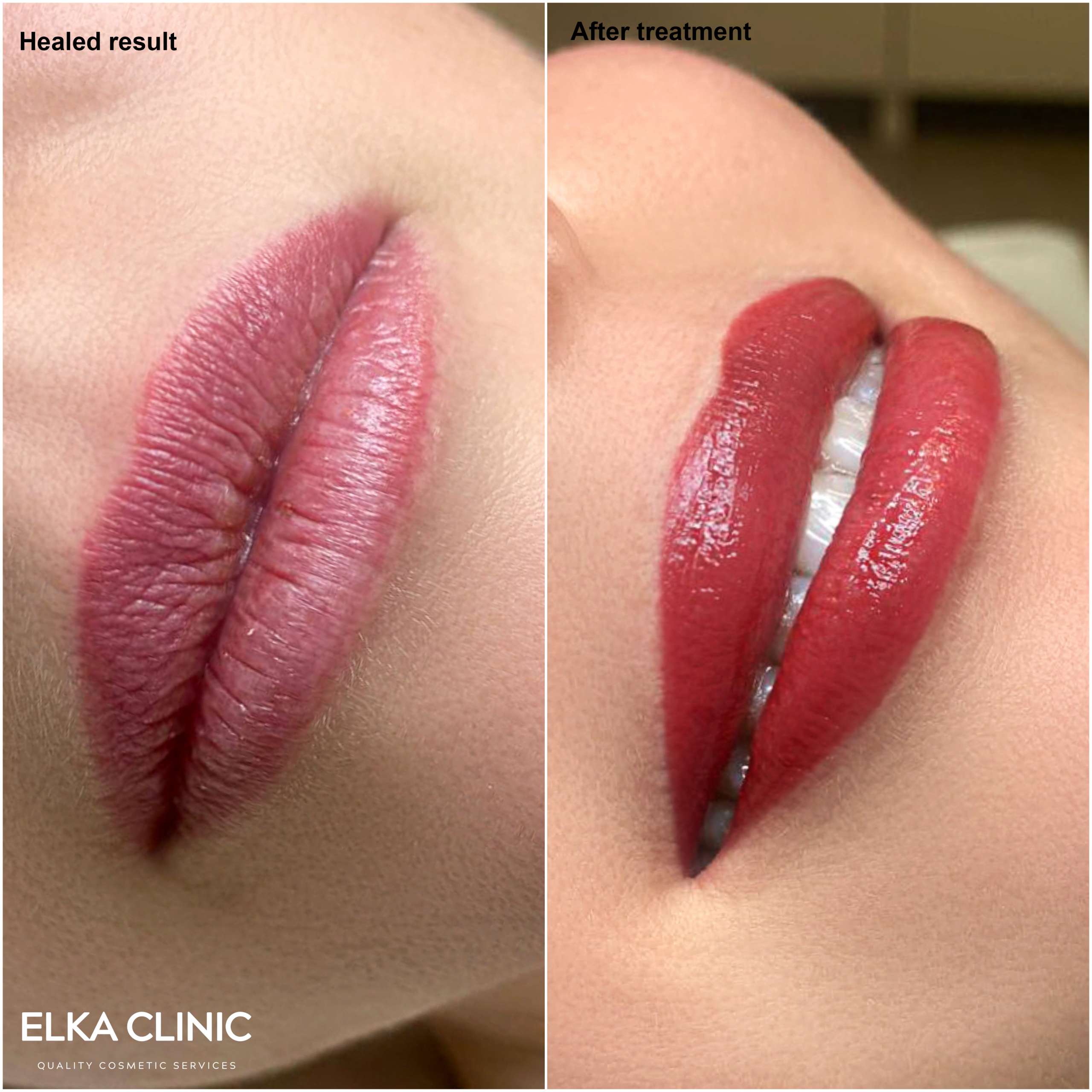 Lip blush tattoo before treatment and healed result side by side, ELKA Clinic Perth