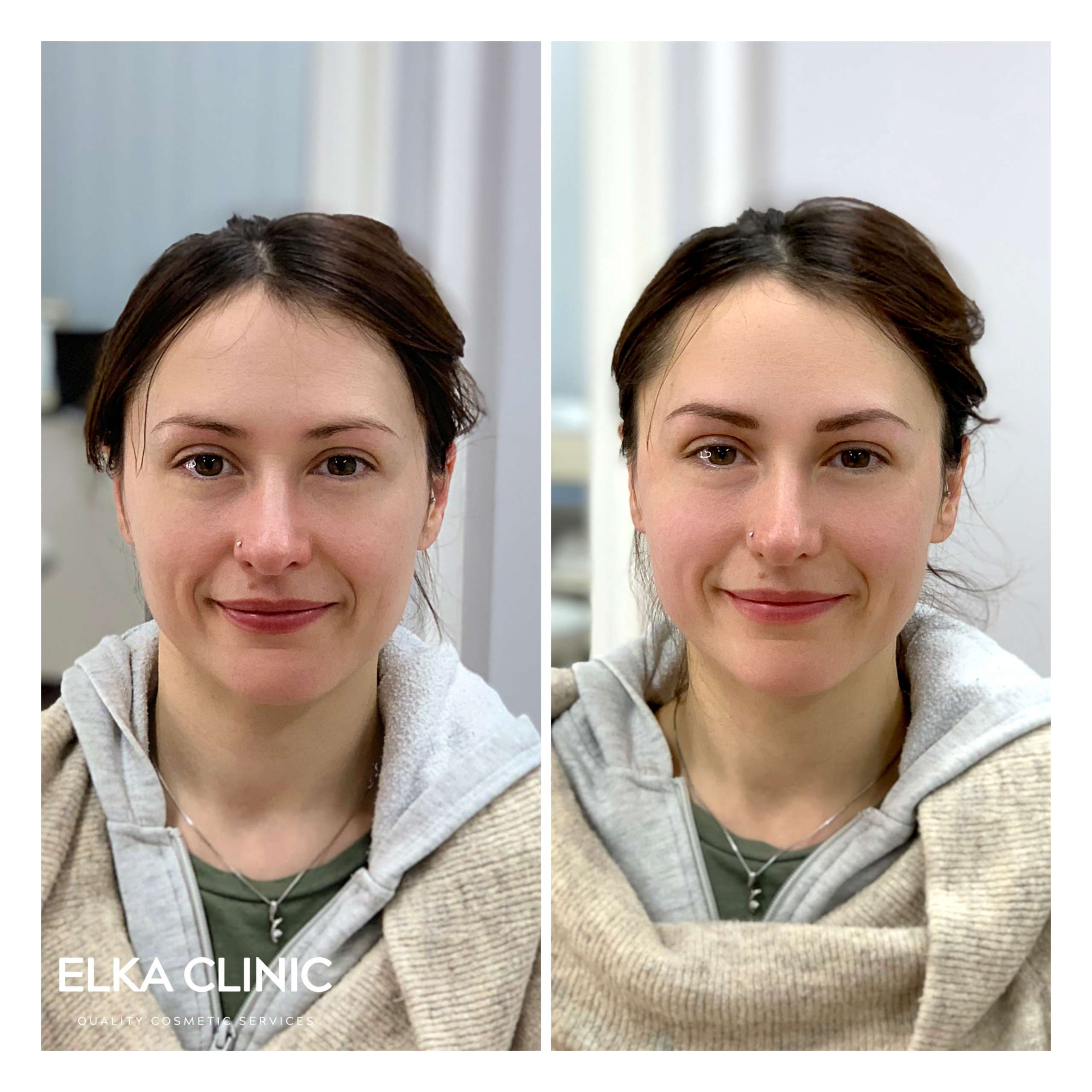 Eyebrow Microblading Before After