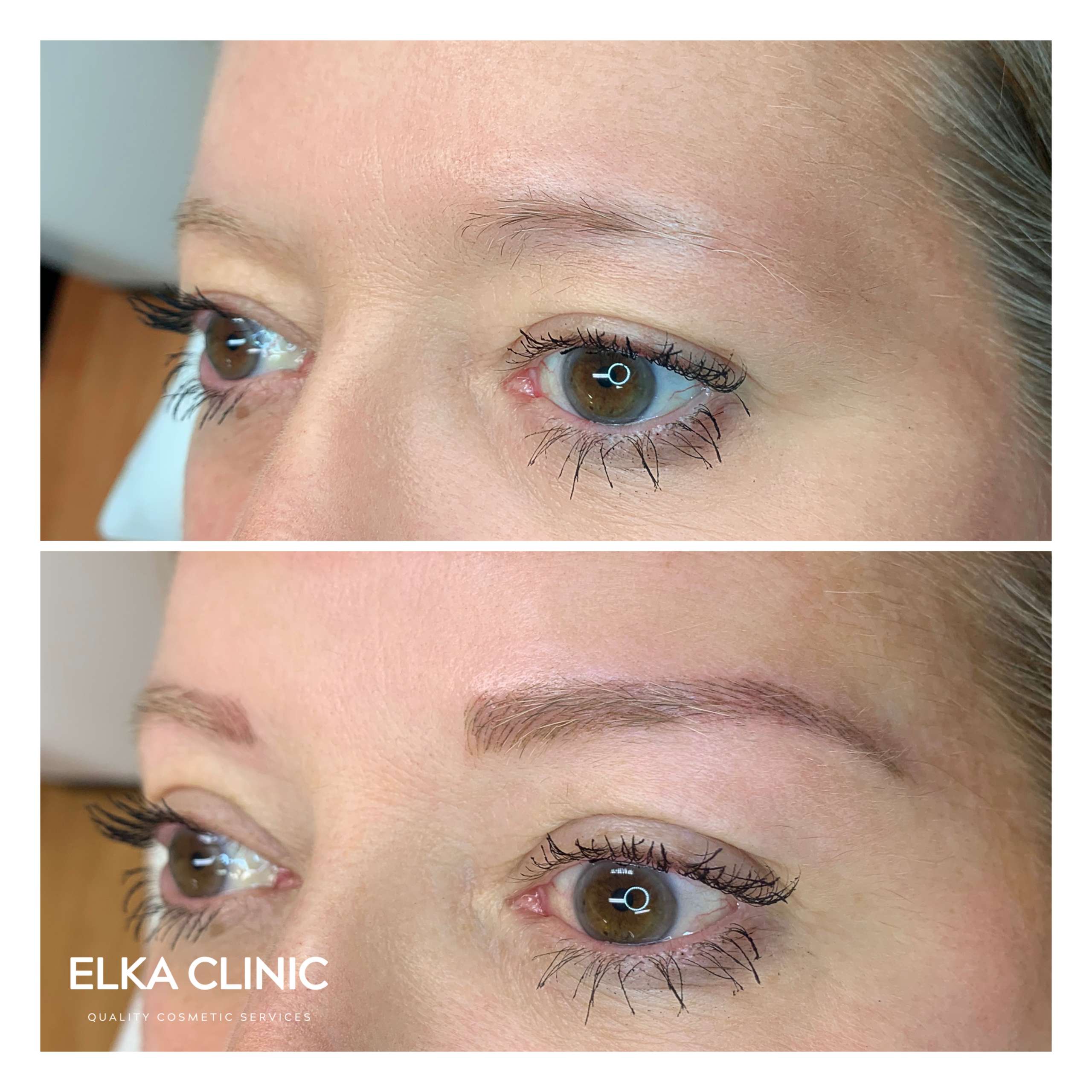 Eyebrow Lifting and changing the shape by ELKA CLINIC