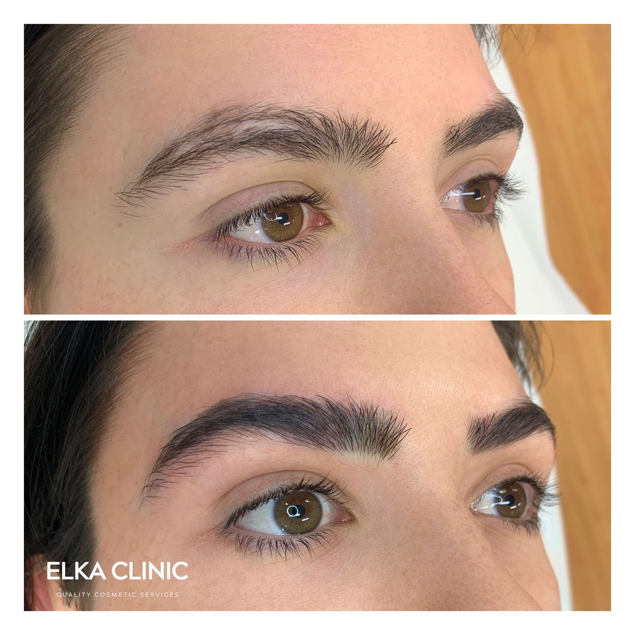 Scar Coverage with Eyebrow Tattooing and Nano brows