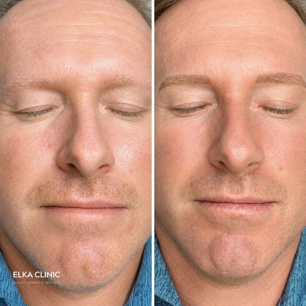 Fair-haired man before and after men’s nano brows, showing light pigment matching at ELKA Clinic Perth