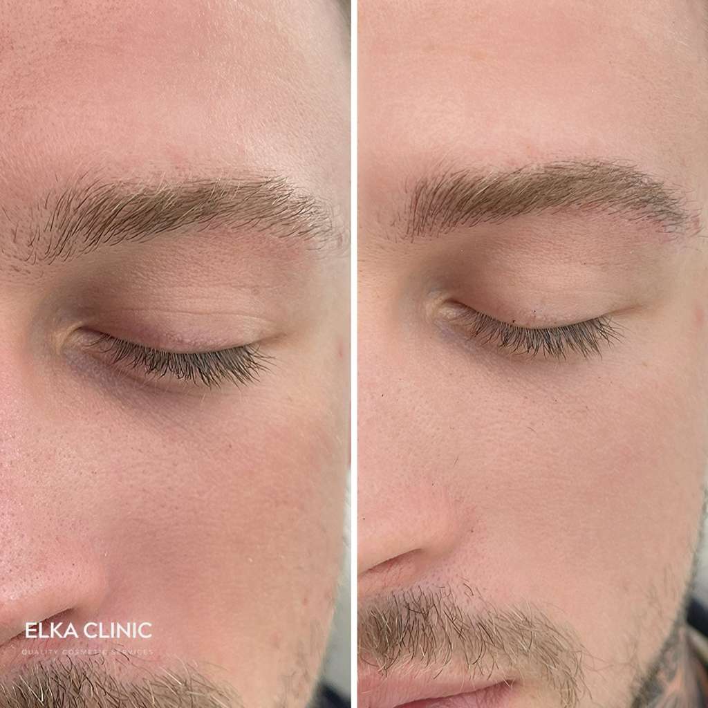 Profile view of men’s eyebrow tattoo before and after at ELKA Clinic, Perth