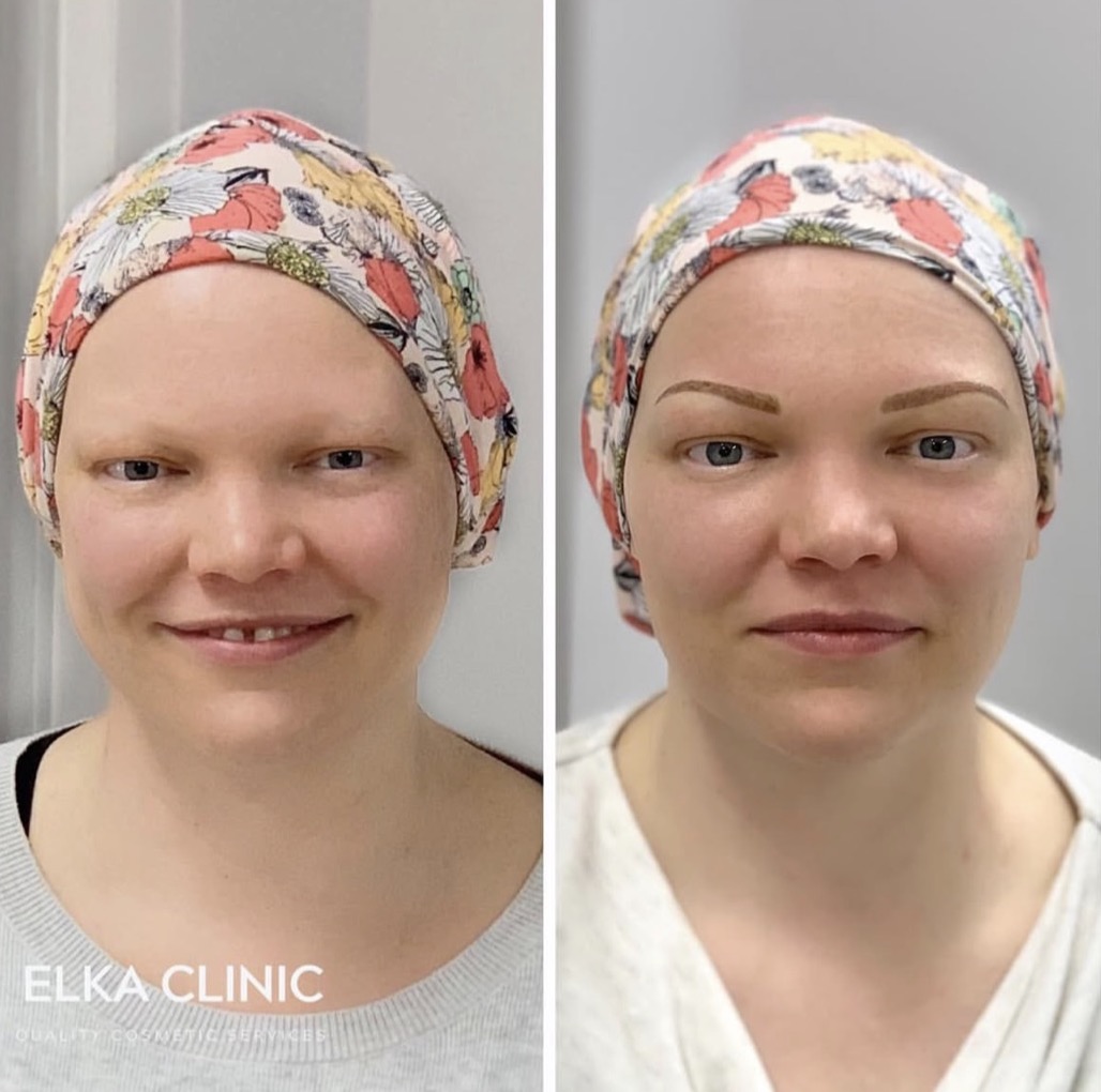 Eyebrow tattoo result for a client affected by hair loss, shown within the ELKA CLINIC treatment room