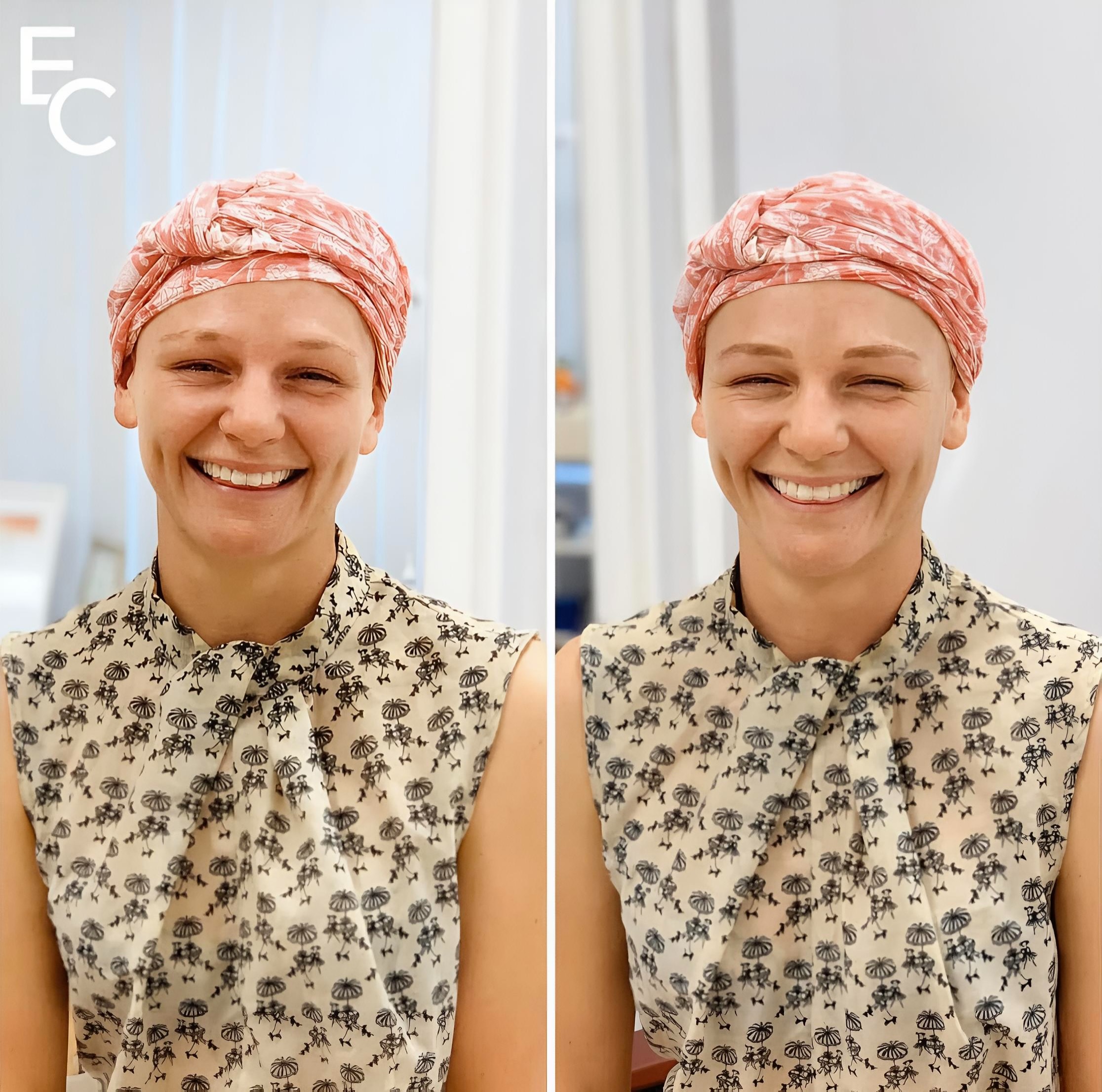 Natural-looking eyebrow tattoo result reflecting ELKA CLINIC's personalised, confidence-focused approach