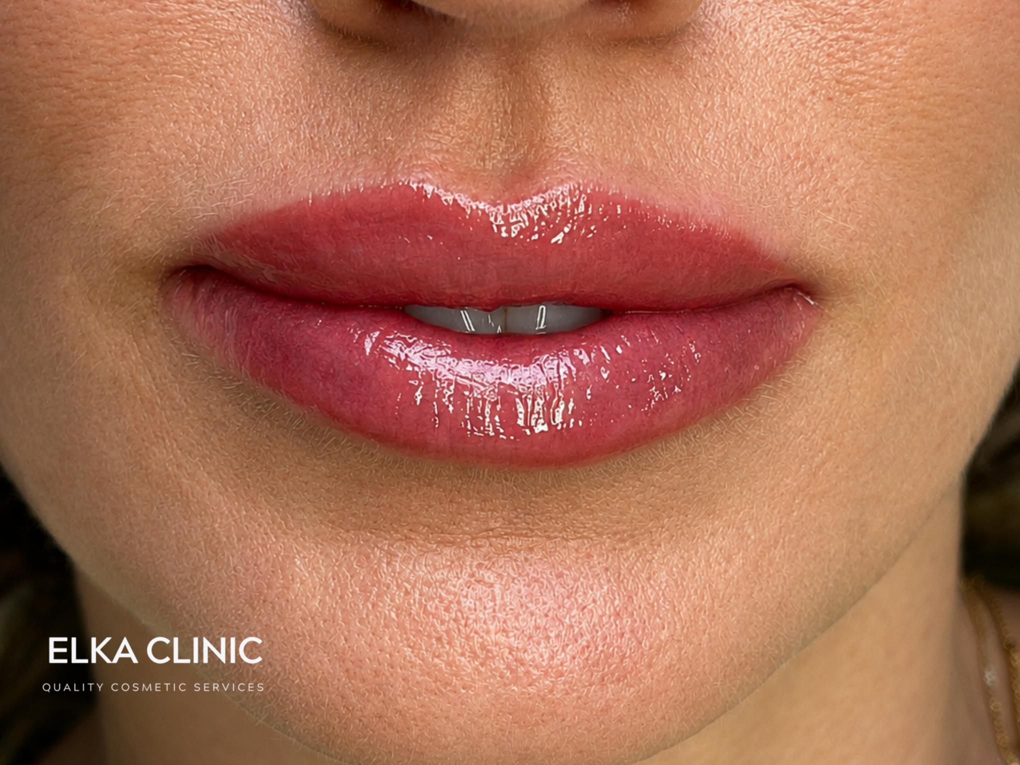Natural everyday lip blush healed result on an ELKA CLINIC client in Perth
