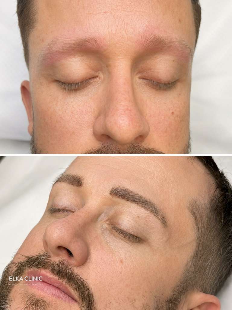 Men’s nano brows before and after a touch-up at ELKA CLINIC Perth