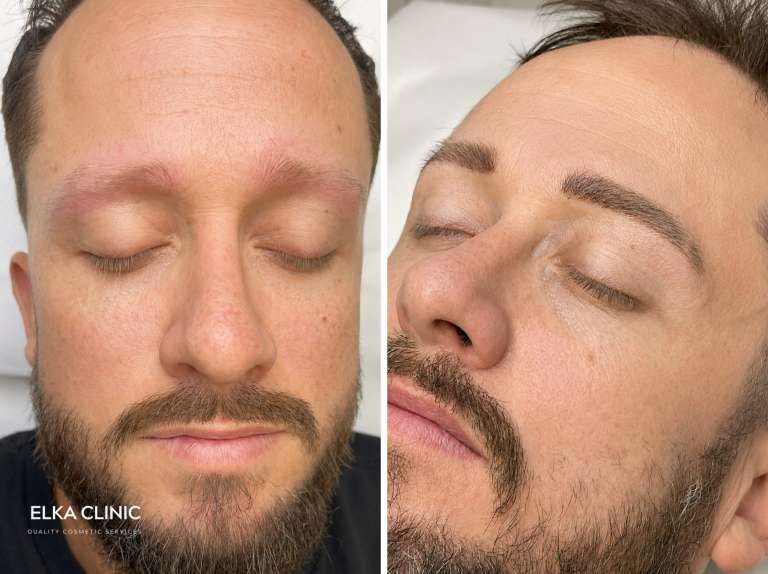 Male client Nano Brows photographed before and after a touch-up appointment at ELKA CLINIC in Subiaco, Perth