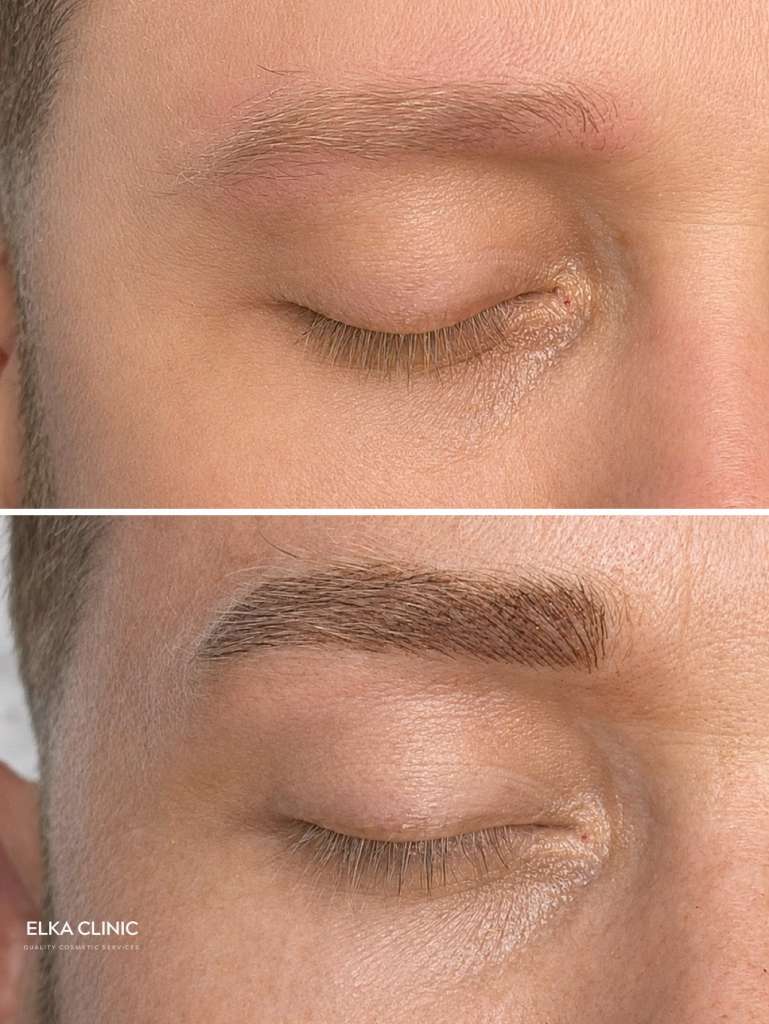 Sparse male eyebrow before nano brows and the same brow after healing at ELKA Clinic Subiaco