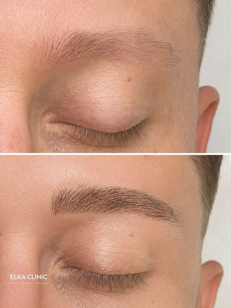 Healed men’s nano brow tail extension shown before and after at ELKA Clinic Perth