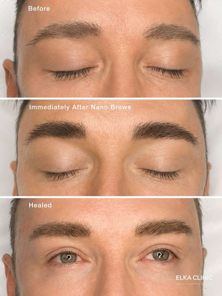 Men&rsquo;s nano brows healing stages: before treatment, immediately after and the healed result at ELKA Clinic Perth