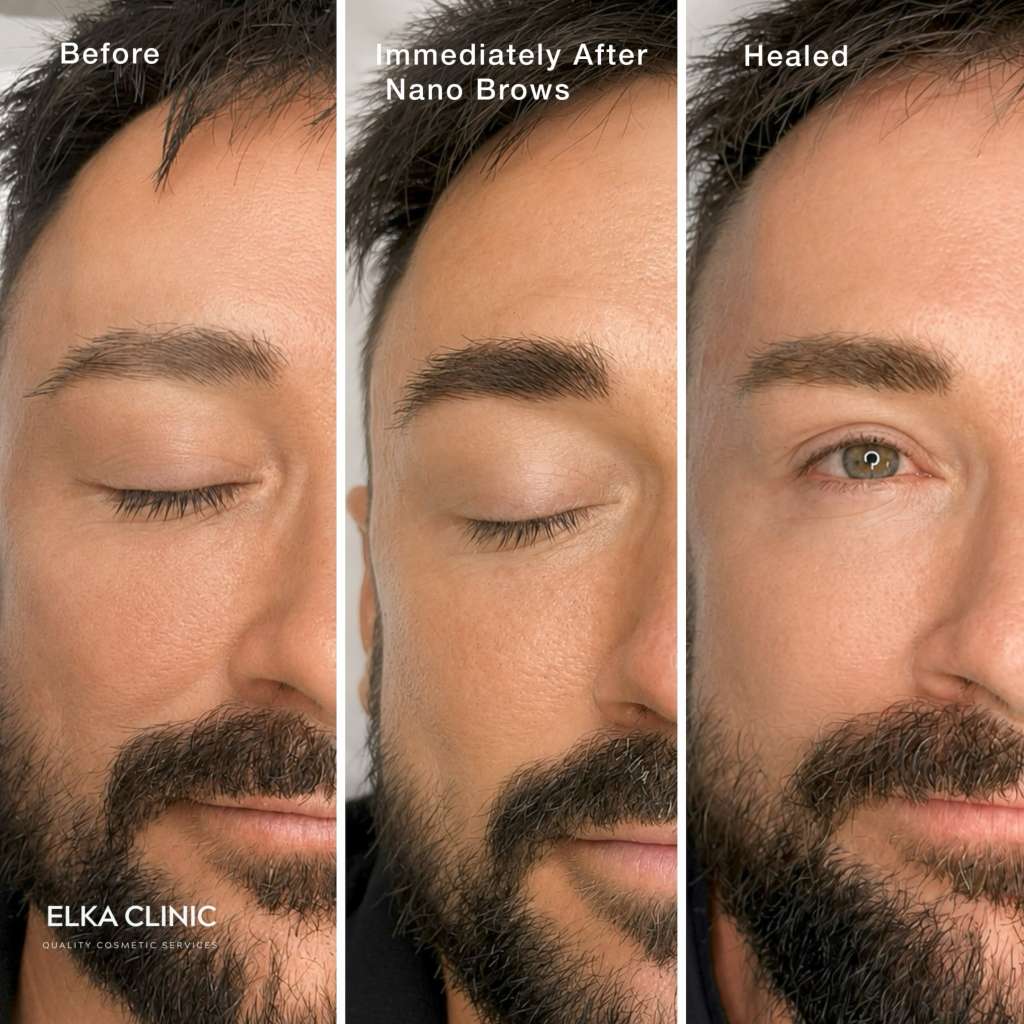 Men’s nano brows shown before treatment, immediately after treatment and once healed at ELKA Clinic