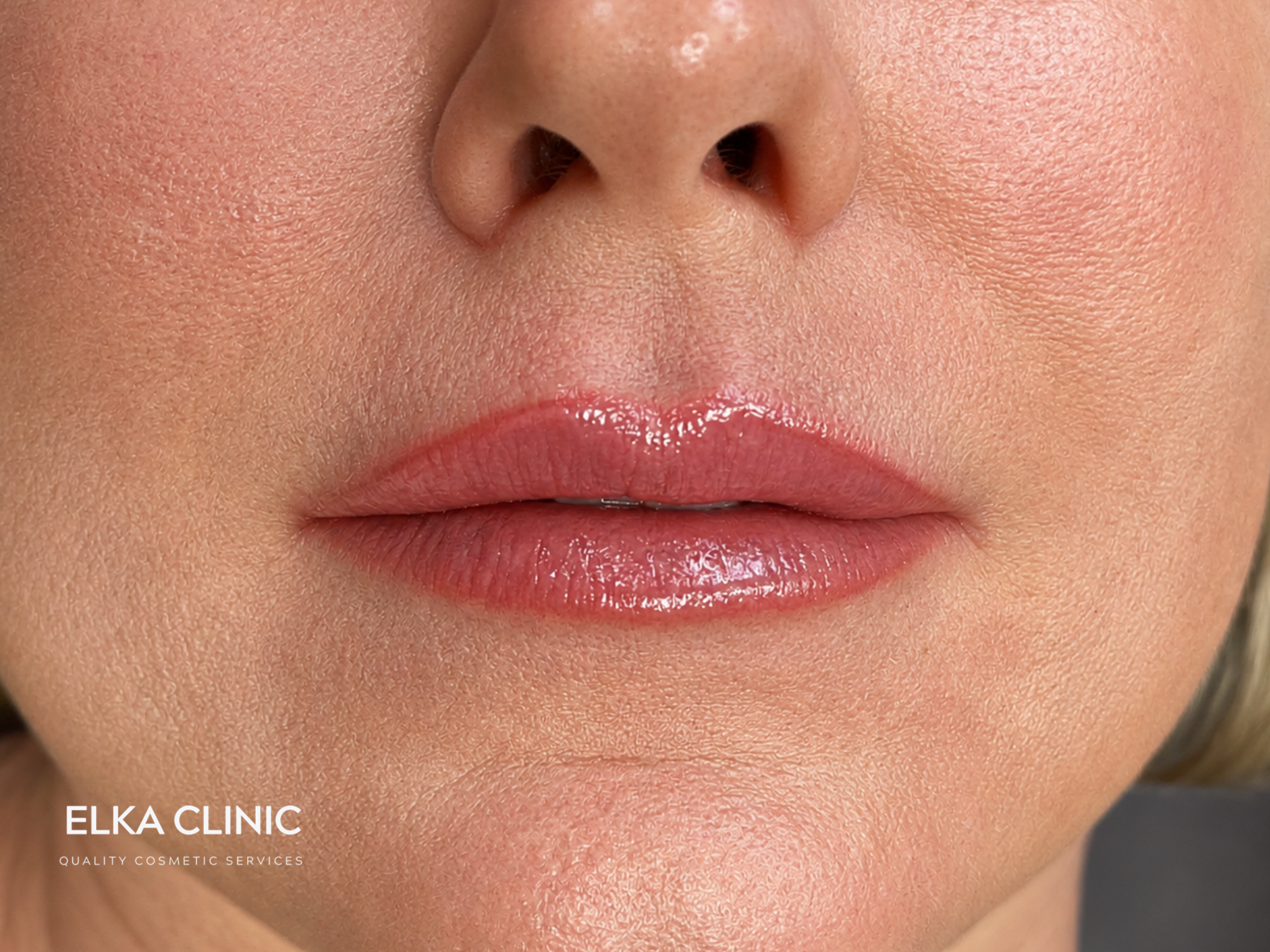 Lip blush tattoo healed result 3 at ELKA Clinic Perth