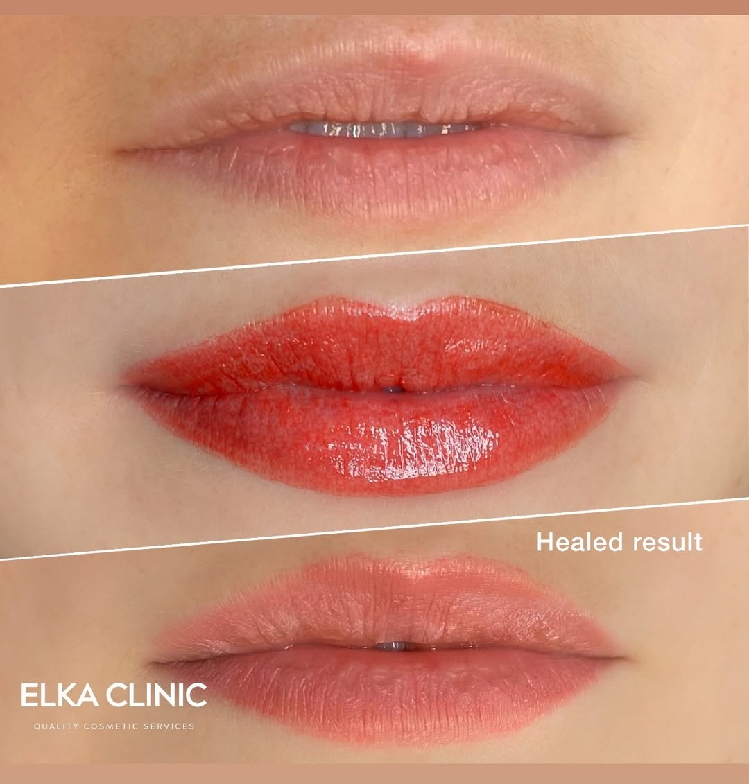 Before, fresh and healed lip blush tattoo comparison at ELKA Clinic Perth