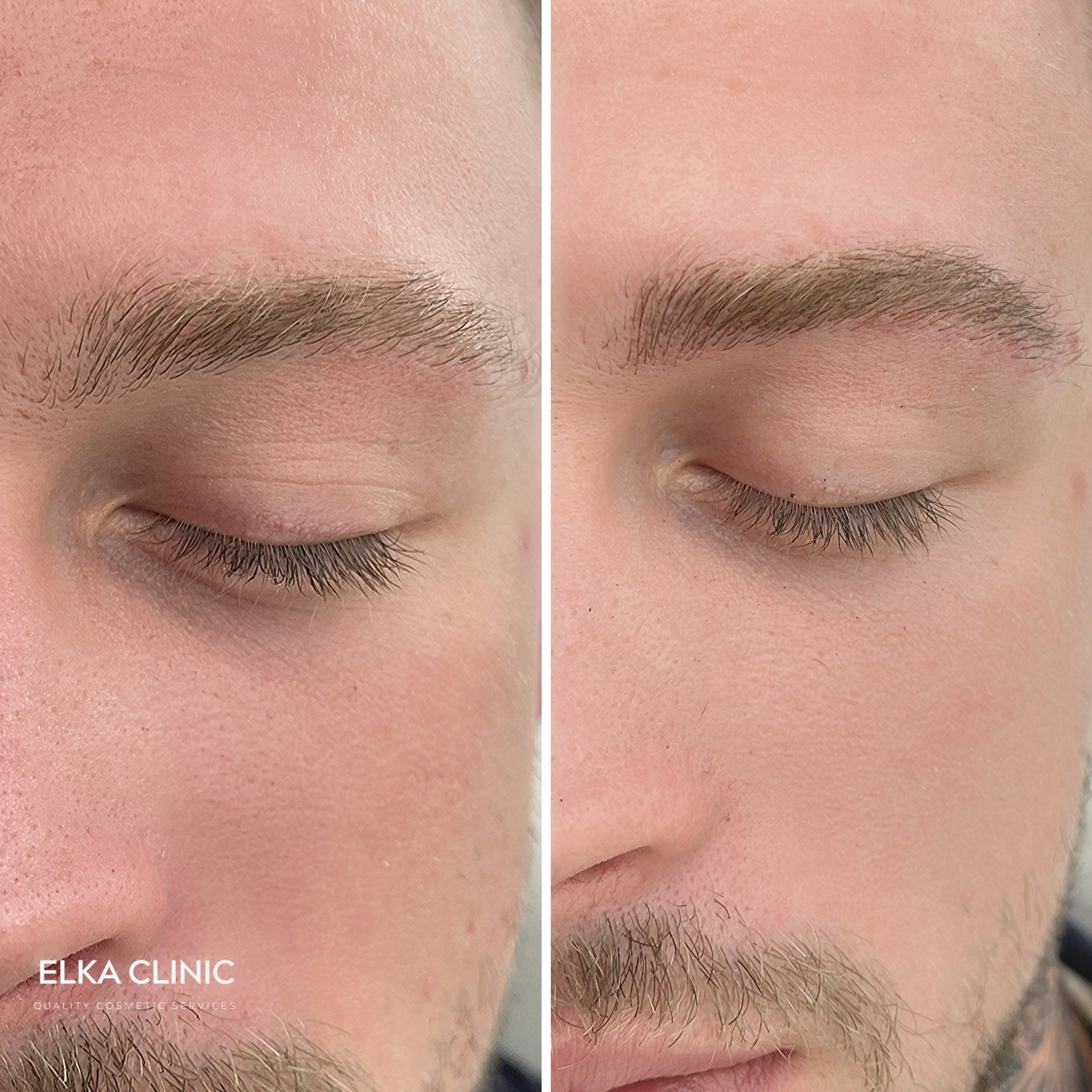 Men's Nano Brows for natural brow definition at ELKA Clinic Perth