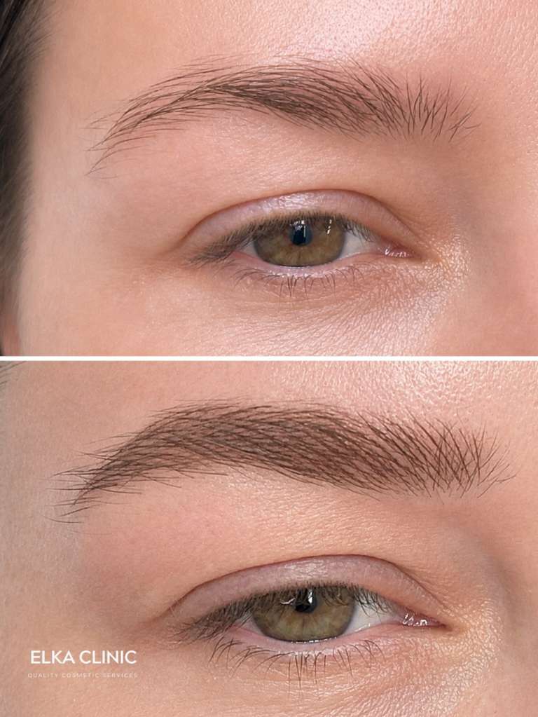 Sparse brows before Nano Brows and the same brows rebuilt with fuller hair strokes at ELKA CLINIC Perth