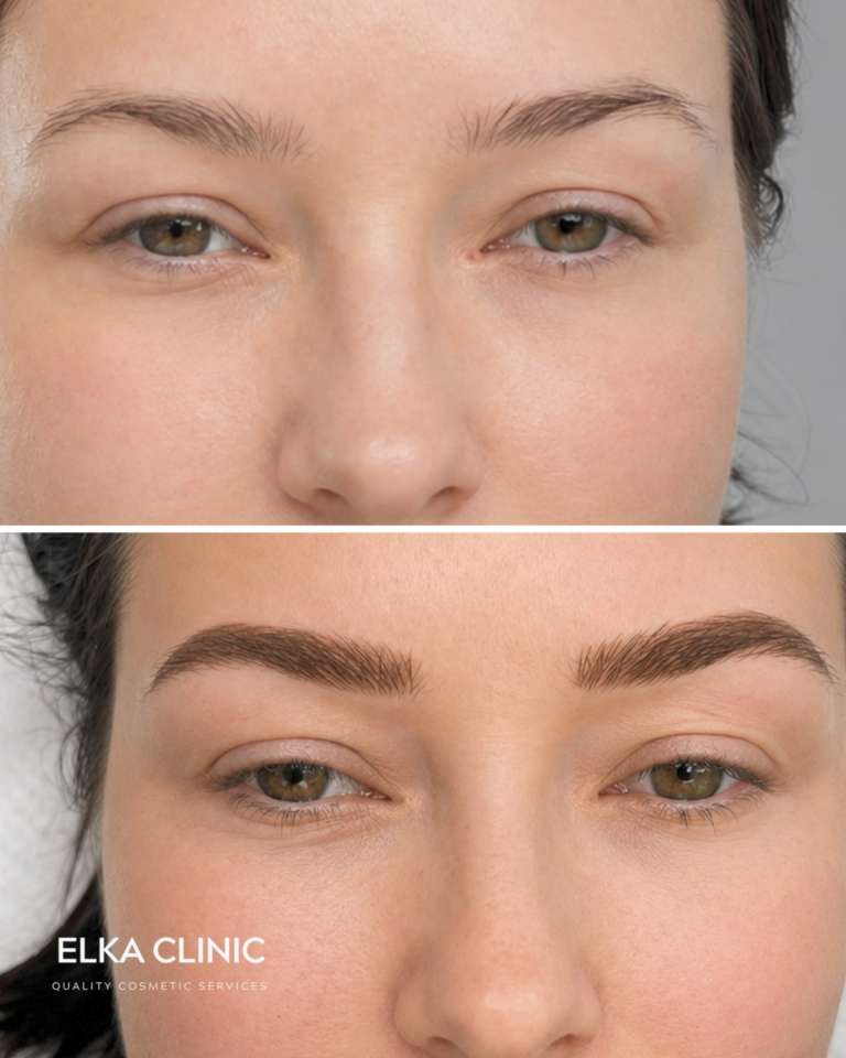 Natural-looking Nano Brows before and after, mapped to the client own brow bone at ELKA CLINIC Perth