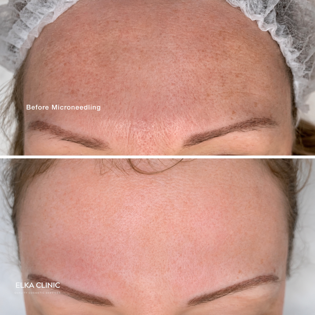 Before and after photographs showing skin tone and clarity on a client’s face, taken at ELKA CLINIC in Perth