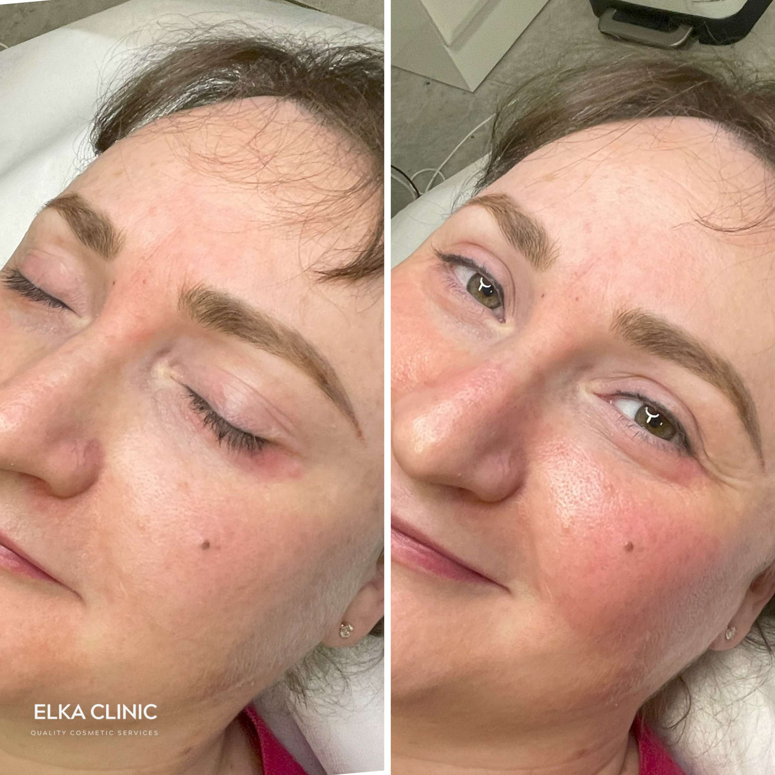 Soft cheek blush tattoo result on an ELKA CLINIC client in Perth