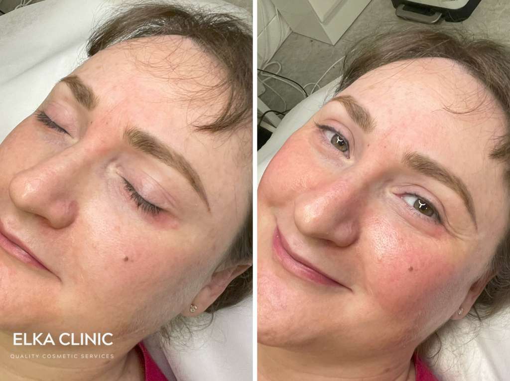 Before and after cheek blush tattoo on an ELKA Clinic client