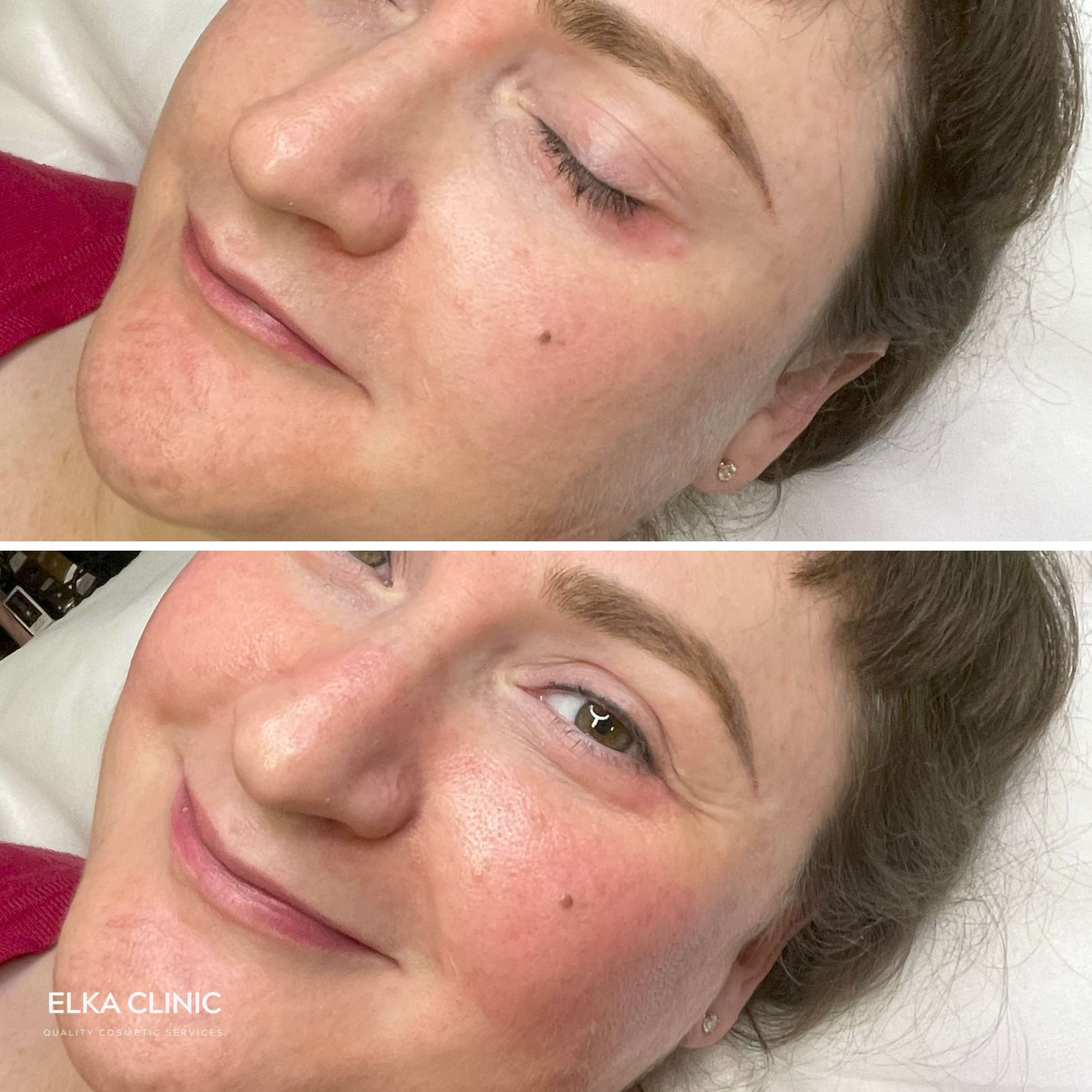 Cheek blush tattoo colour placed across the apples of the cheeks at ELKA CLINIC Perth
