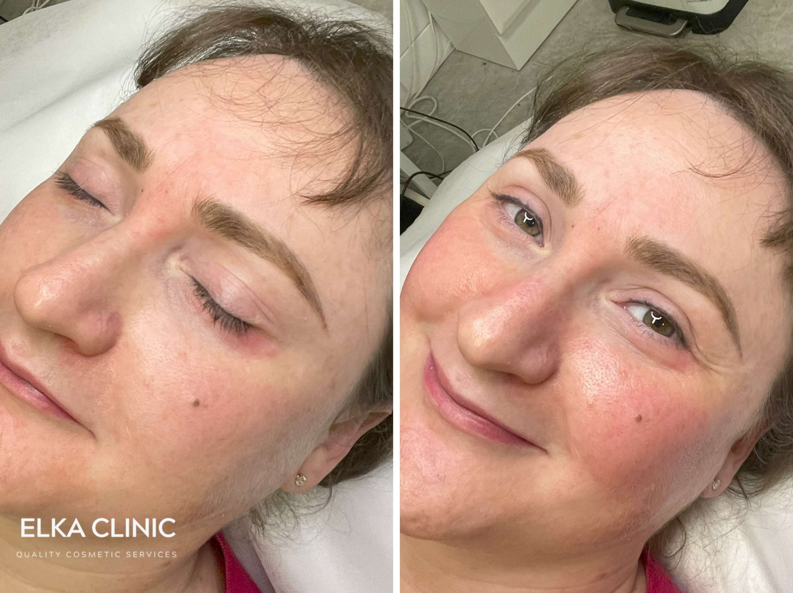 Cheek blush tattoo healed result on an ELKA CLINIC client in Perth