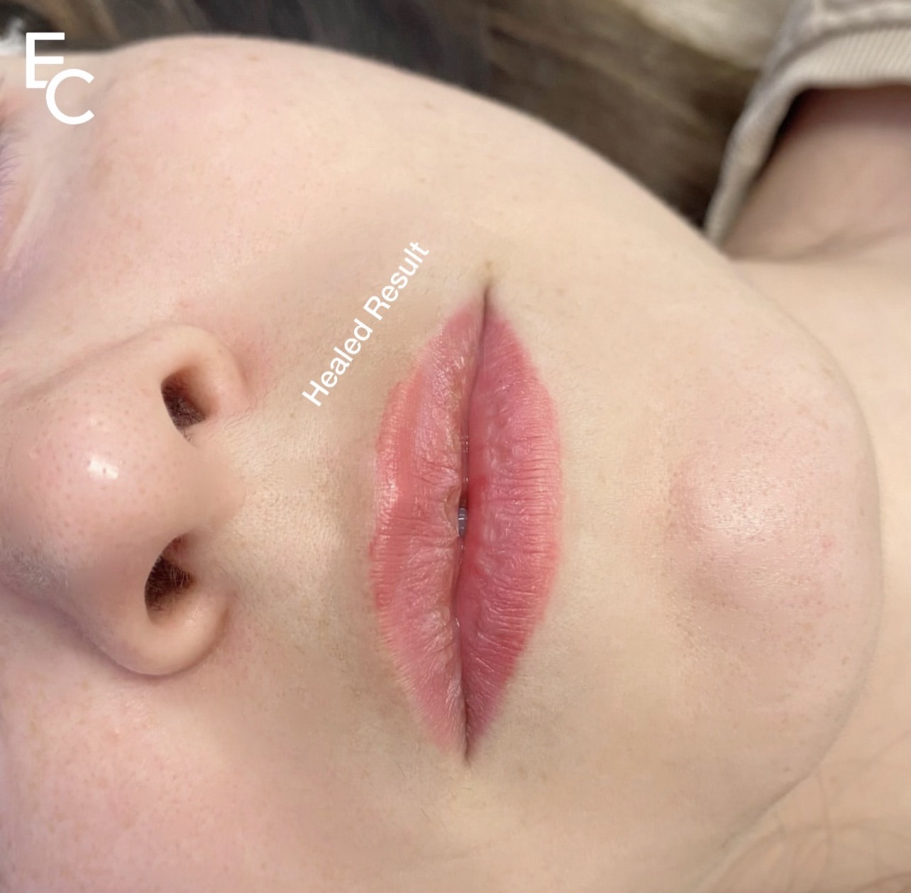 Healed lip blush tattoo result at ELKA CLINIC Perth