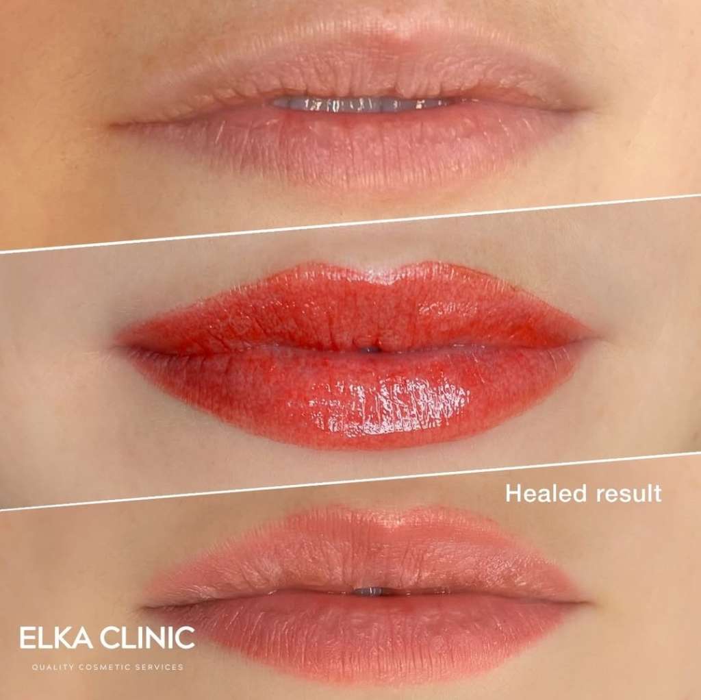 Lip blush tattoo before, immediately after and healed at ELKA CLINIC Perth
