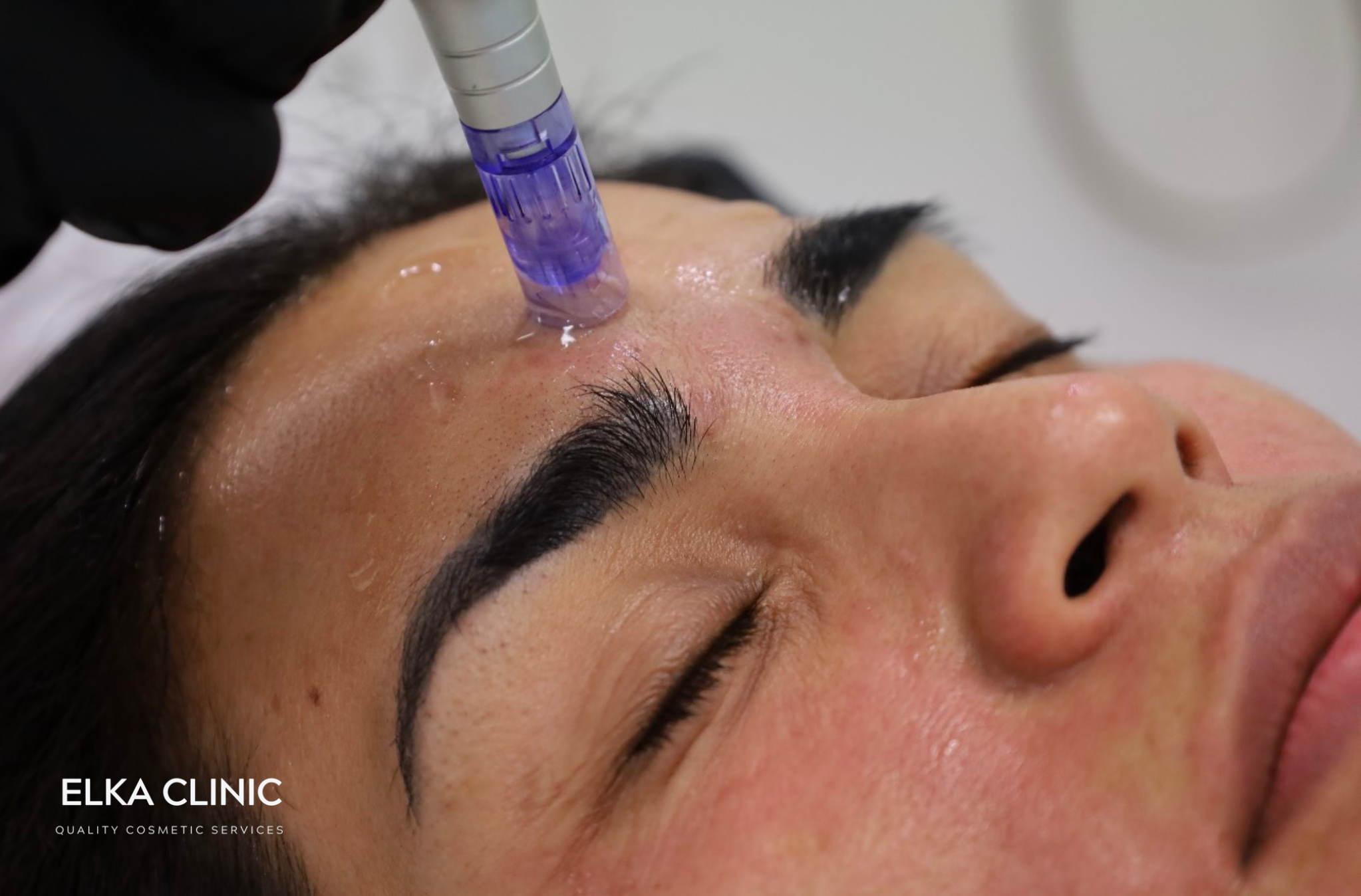 Microneedling in progress at ELKA CLINIC Perth