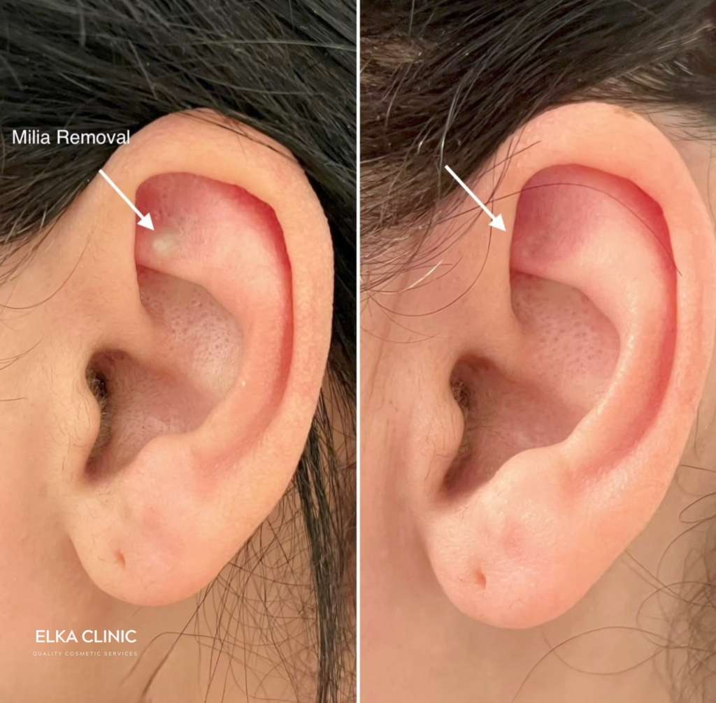 Before and after photographs of milia removal with Plasma Pen at ELKA CLINIC in Perth