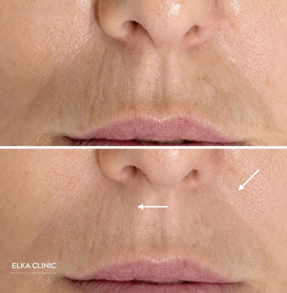 Before and after photographs of enlarged pores around a client’s mouth and chin, taken at ELKA CLINIC in Perth