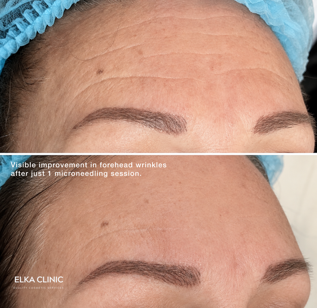 Before and after photographs of forehead wrinkles on a client’s forehead, taken at ELKA CLINIC in Perth