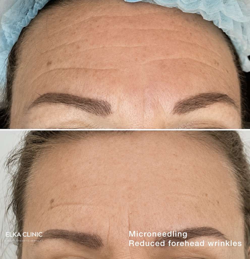 Before and after photographs of forehead wrinkles on a second client’s forehead, taken at ELKA CLINIC in Perth