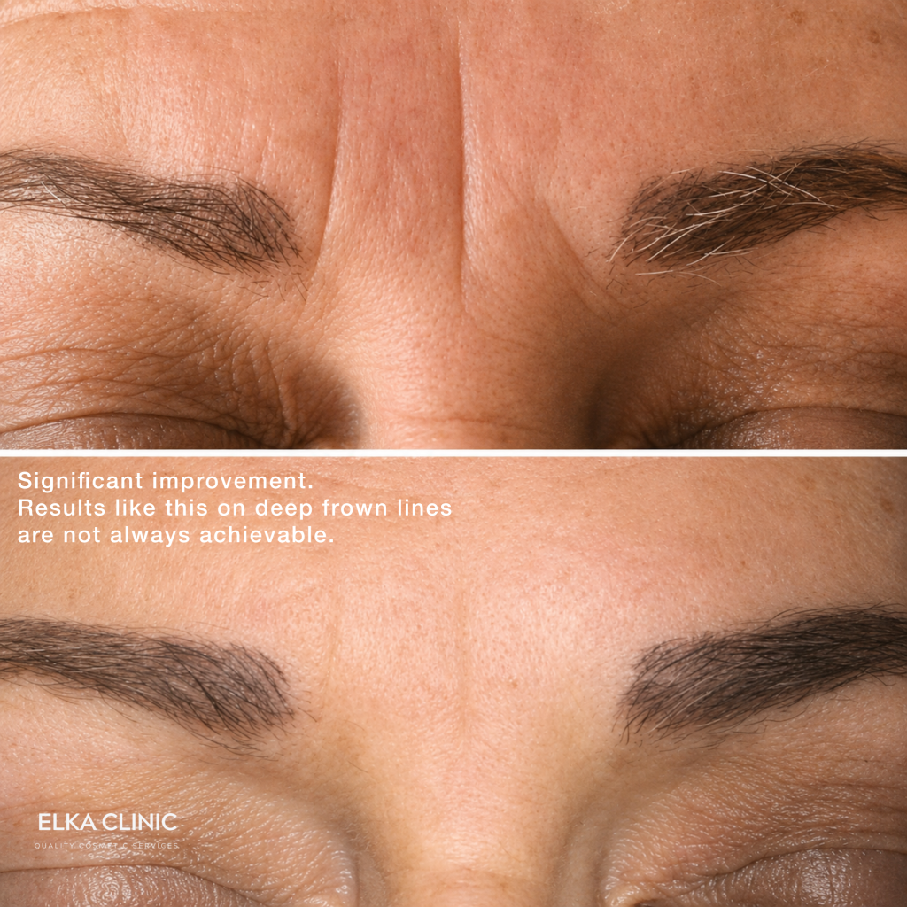 Before and after photographs of forehead wrinkles on a third client’s forehead, taken at ELKA CLINIC in Perth