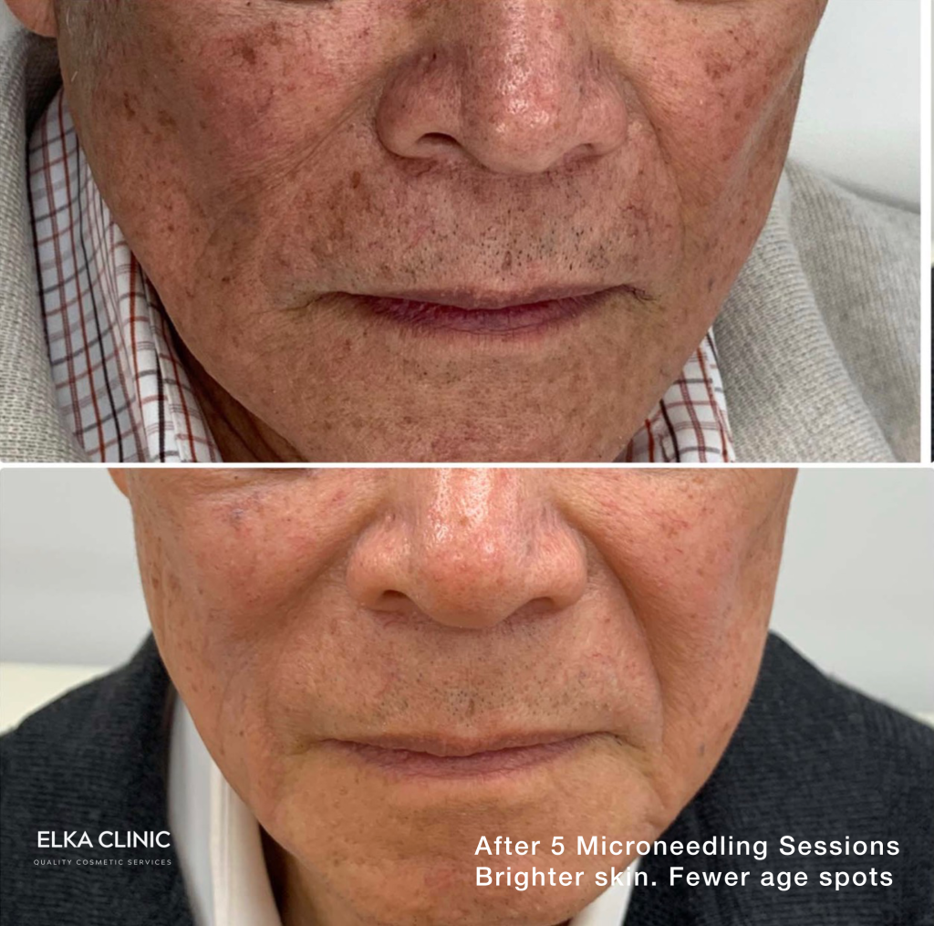 Before and after photographs of age spots on a client’s skin, taken at ELKA CLINIC in Perth