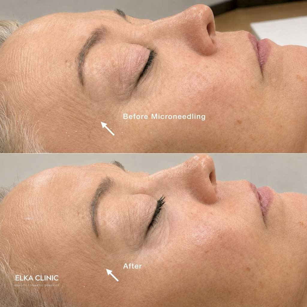 Before and after photographs of fine lines on a client’s face, taken at ELKA CLINIC in Perth