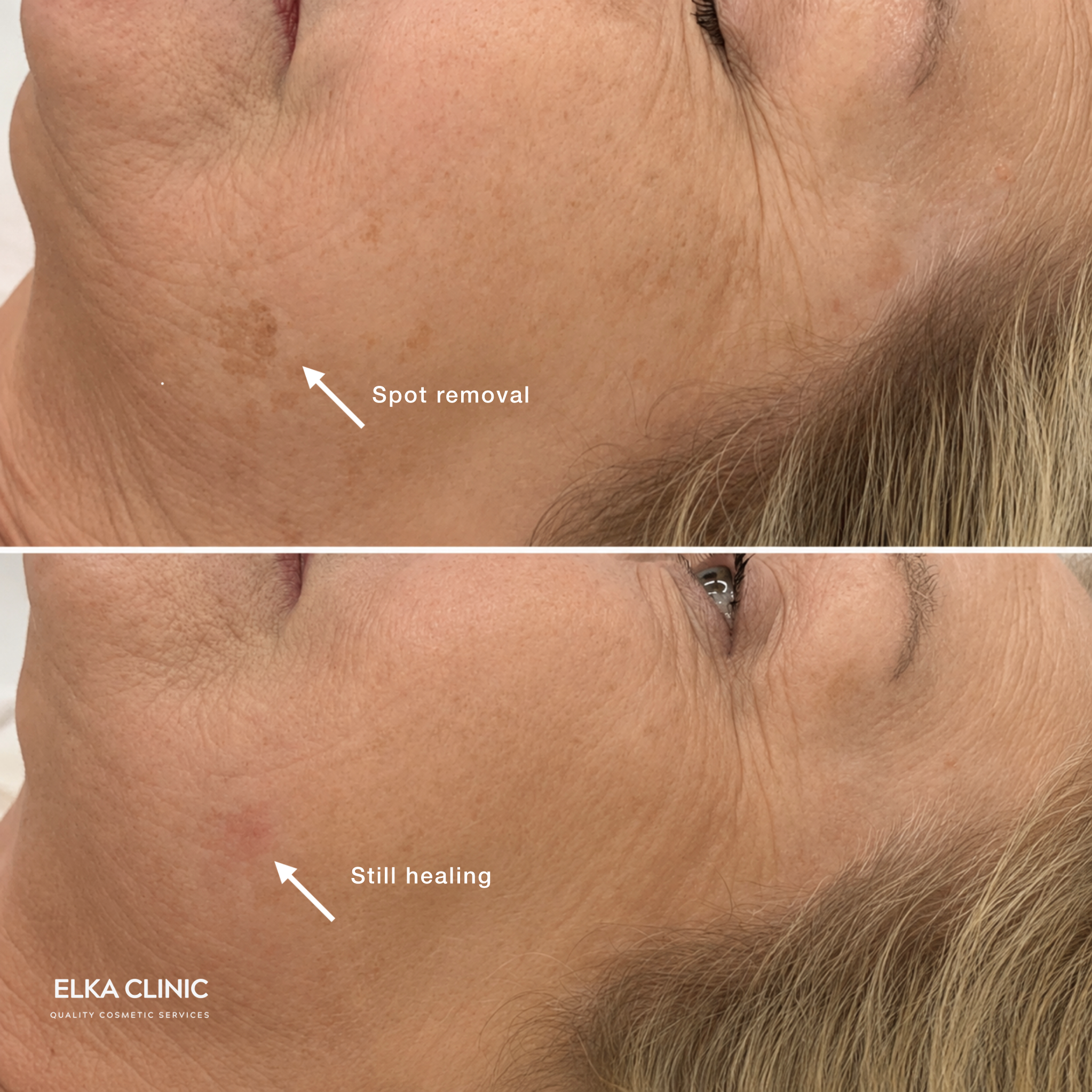 Fine lines reduced before and after microneedling at ELKA CLINIC Perth