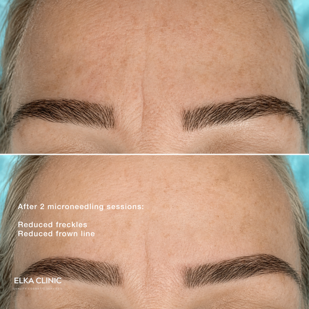 Before and after photographs of freckles and frown lines on a client’s face, taken at ELKA CLINIC in Perth