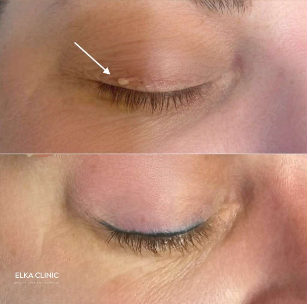 Before and after photographs of benign skin lesion removal near the eyes with Plasma Pen at ELKA CLINIC in Perth (photograph one of two)