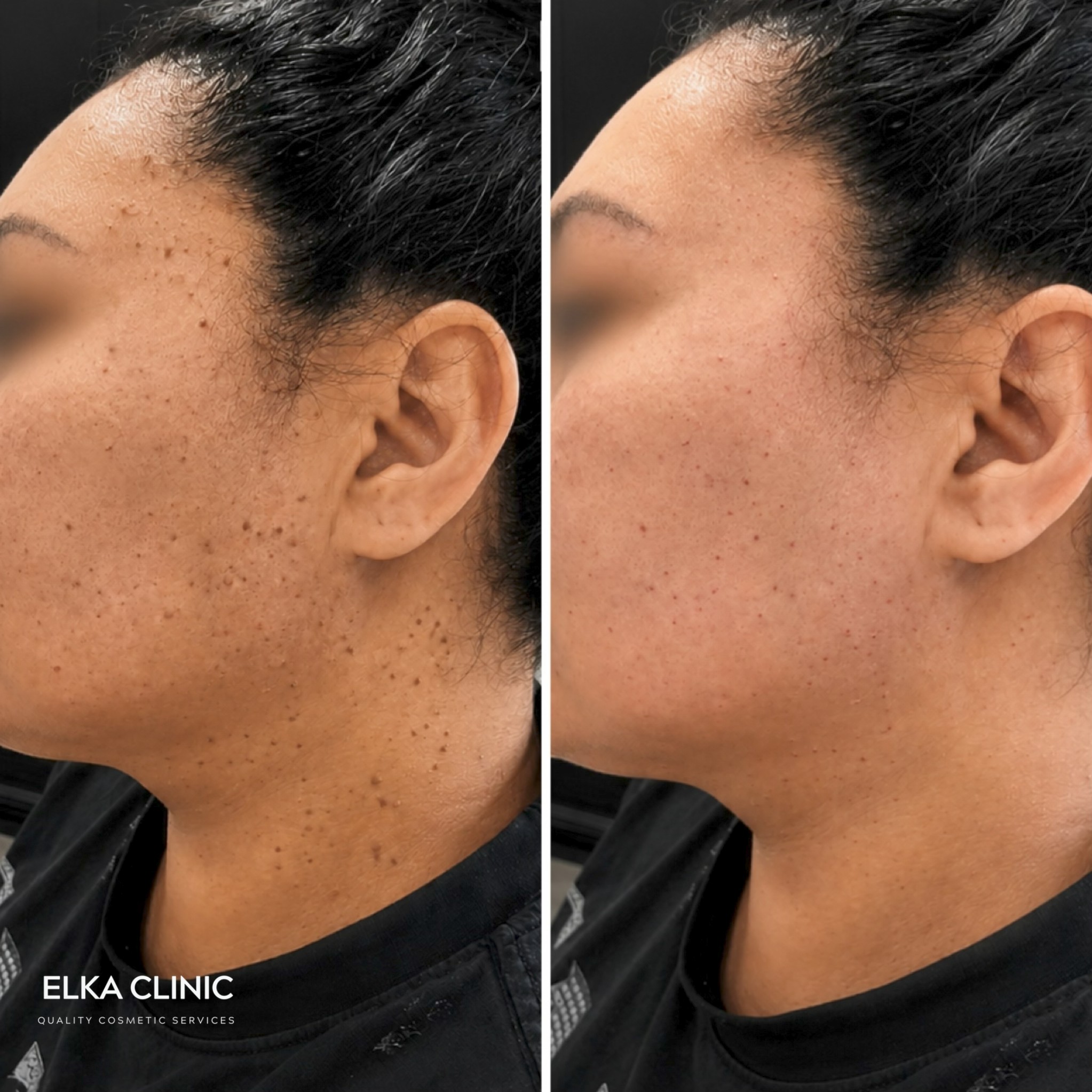 Facial skin tag shown before, immediately after and healed following plasma pen removal at ELKA CLINIC Perth
