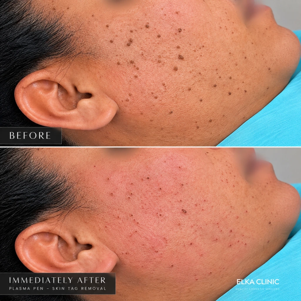 Before, immediately after and healed results of Plasma Pen skin tag removal on the face at ELKA CLINIC Perth